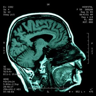 علاج أمراض المخ والأعصاب بنجاح كبير بالخلايا الجذعية المزدوجة 6